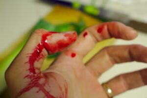 Een hand met een wond aan de duim die erg bloed.